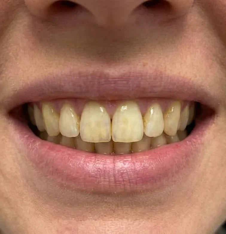 Souq Aura Whitening Strips