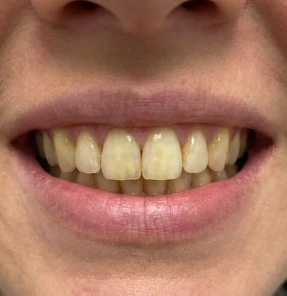 Souq Aura Whitening Strips